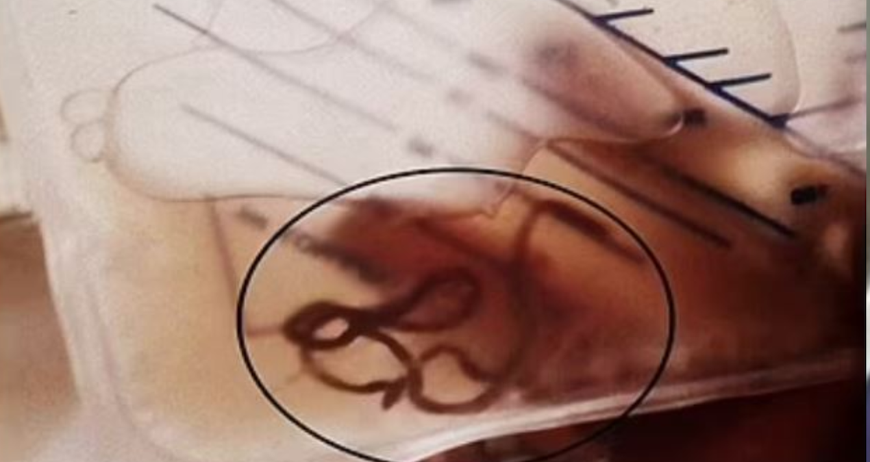 Çiğ çiğ yediği o besin yüzünden idrarından solucan çıktı: Bu hatayı yapmayın!